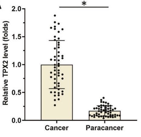 The expression of TPX2 in HCC clinical specimens.jpg